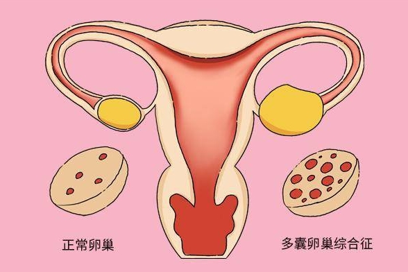 治疗多囊卵巢医院华博 治疗多囊医院排名