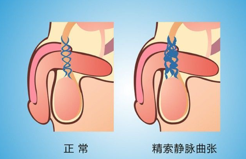 精索静脉曲张哪个医院
