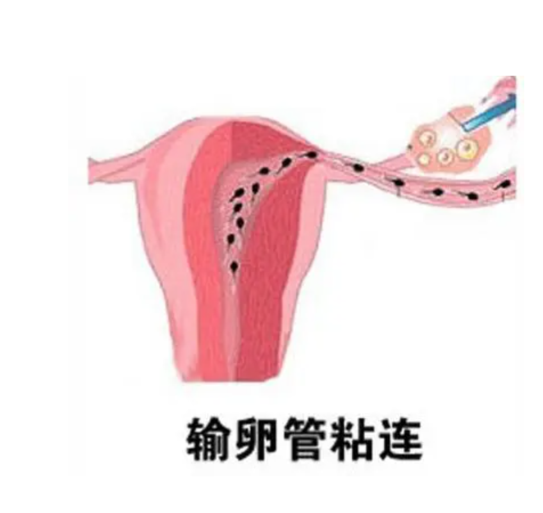 哪个医院看输卵管伞端粘连看的好