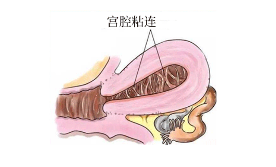 宫腔粘连可以做试管吗？
