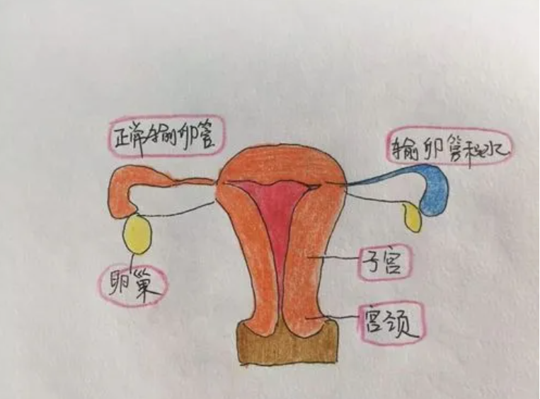输卵管积水是什么原因引起的？这种情况能做试管婴儿吗？