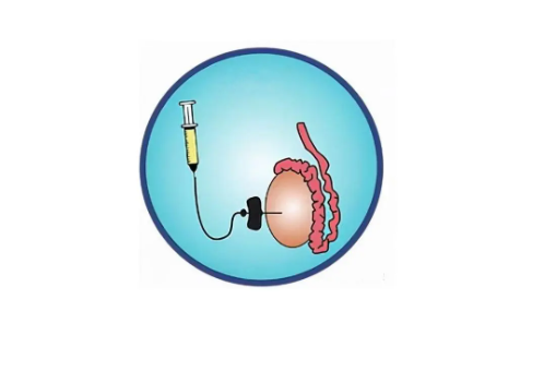 睾丸穿刺多少钱（无精症穿刺大概费用多少）