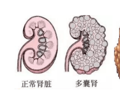 多囊肾风险知多少？三代试管婴儿基因检测更安心