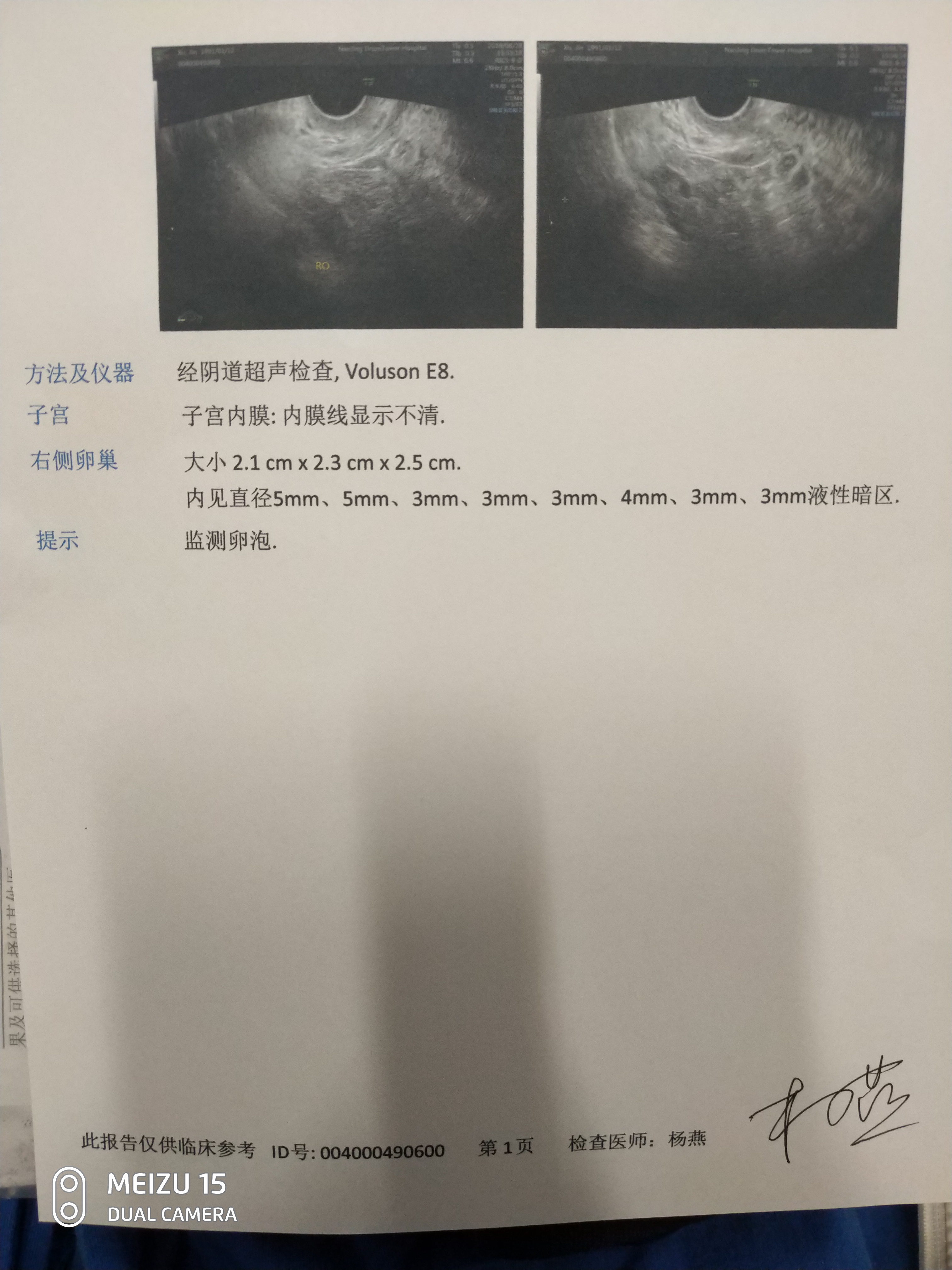 准备进行第二次移植，2个8细胞胚胎解冻后还是8细胞，我把这两个胚胎做了孵化，我怕透明带厚了影响他们破壳出来，所以做了个孵化，我问了实验室的医生，说这个可以辅助着床，增加着床机率，但作用不大，所以是否孵化大家自己决定。在移植前我就做好了不成功的准备，毕竟已经移植四次了，全是不明原因的失败，身体各方面查不出来问题，就是不成功，大夫又说我卵子质量不好，所以对这次也没有报什么希望，就想着大不了重头再来，重新促排一次。