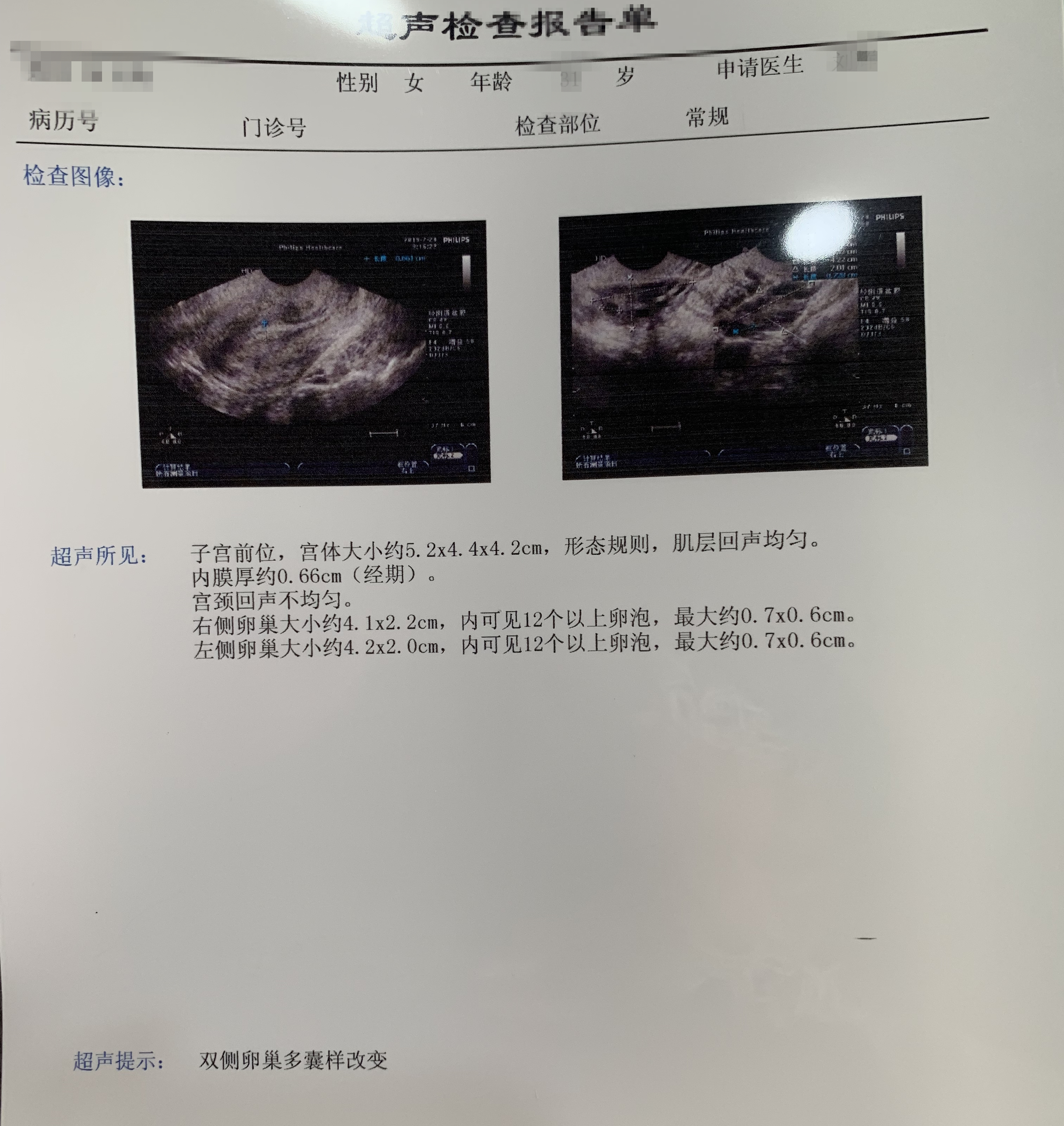 24岁那年，我披上婚纱嫁给了我最爱的人，然而备孕4年，输卵管原因、宫腔黏连，多囊卵巢综合征这些原因压得我喘不过气，中西药也调理、宫腔镜手术也做过，但是“两道杠”从来没有光顾过，我决定给自己最后一个机会，去做试管。