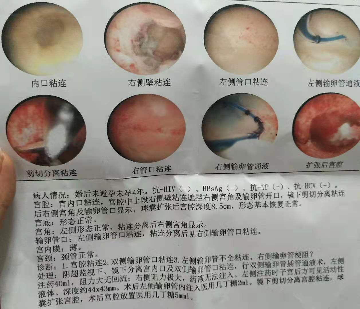 9月份阴超显示内膜过厚囊肿未消，主任建议月经干净做宫腔镜检查，贝贝壳的生殖顾问便提前给我预约了宫腔镜室，结果显示内膜息肉、输卵管内口粘连，就做了粘连分离、息肉摘除术。术后消炎等下一次月经。