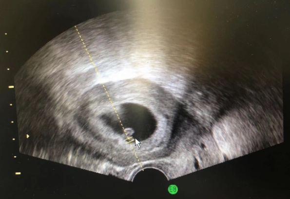 第六次移植，我真的非常着急，就剩下一个胚胎了。主任说这次把所有的因素通盘考虑一遍，就这样我在移植前做了宫腔镜，还打了生长激素，还增肥了。经过生殖顾问的开导心态相对也比较好了些（毕竟保险说是三次移植失败再赔付一次促排和移植）。就这样移植了最后一个囊胚等待“开奖”。
其实到了最后一次我跟老公商量本来是顺其自然，要是再没有中就不做了。结果第10天查试纸竟然强阳，结婚这么久第一次看到强阳啊！好兴奋！老公当时还傻乎乎的怀孕是试纸问题。到第14天抽血血值也很高！