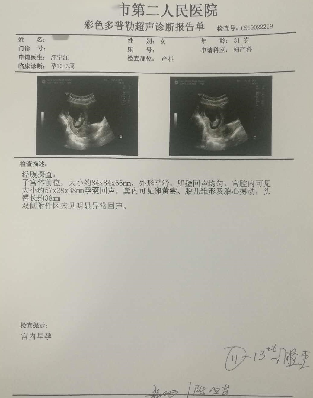 2019年4月28日，移植了2个卵裂胚胎，我想是老天爷看到了我为此付出的努力，所以让我顺利的怀上了宝宝，所以大家如果没有避孕正常性生活一年为怀孕的话，就一定要早看医生，需要做试管的话就尽早试管。