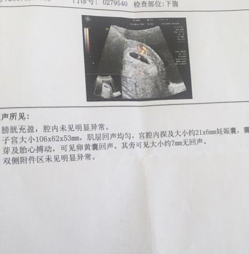 试管婴儿