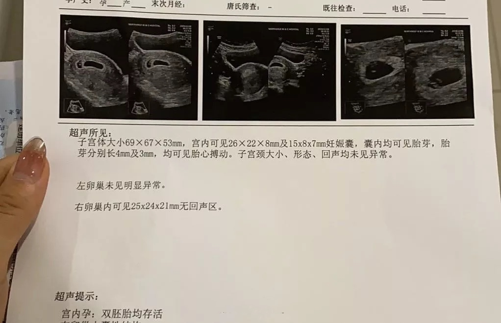 2020年4月20号，我早早去医院进行移植手术。根据我的身体情况，管主任决定采用序贯移植的方法，移植两枚胚胎到我体内。移植过程感觉就像TCT，但是实际不大一样，医生通过一根管子打枪一样把胚胎放到内膜上就好了。可以看到内膜上胚胎小小的亮亮的。移植完以后大概了躺了20分钟就可以去方便了，之后再躺半小时就可以回家了。

劳动节那天，我忍不住测试了一下，两条杠，我生怕自己眼睛花了，又拿给爱人看，确认是双杠。他一再安抚我，莫激动，还得去医院确认。第二天一早，生殖管家就到了，然后她见证了我的B超结果，怀孕了。不过她还是提醒我，要注意翻倍情况，要注意休息和营养。5月18号再次去医院，HCG105760.5miu/ml，B超提示双绒双羊，双活胎！把婆婆激动的当场就哭了，说我超额完成了任务。