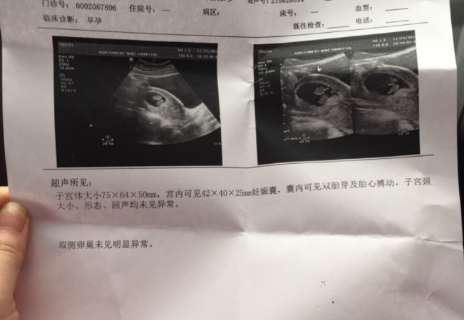 等一超的心不亚于14天的焦灼，移植16天自己偷偷去别的医院看的翻倍，结果8080，心想有可能双胎，终于熬到一超，大夫也说双胞胎，都有了胎心，那一刻还是懵的，回家缓了几天，失眠了几天，突然有了前所未有的压力。考虑生产危险，考虑经济问题，考虑老公身体...